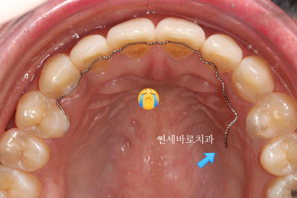 벌어진 치아교정 / 고정식 철사 유지장치의 필요성과 유지장치 이유