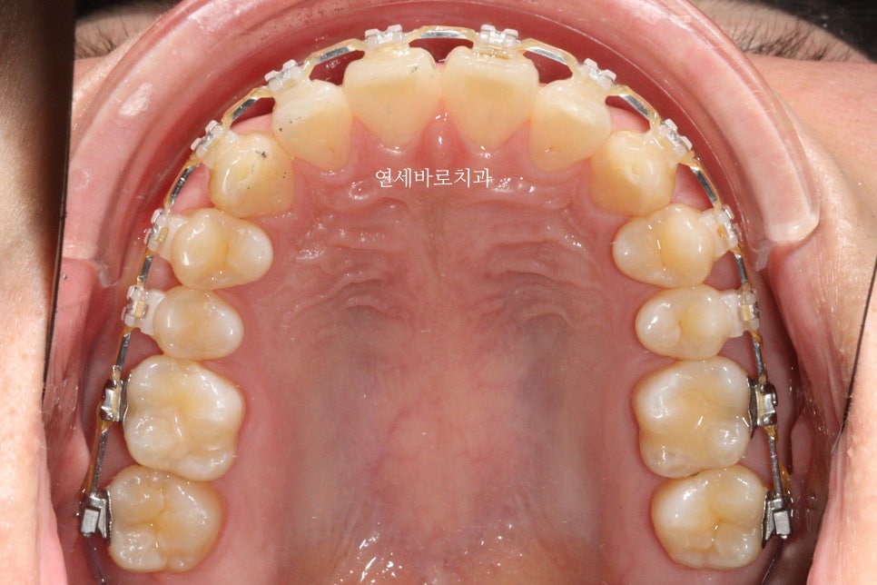 벌어진 치아교정 / 고정식 철사 유지장치의 필요성과 유지장치 이유