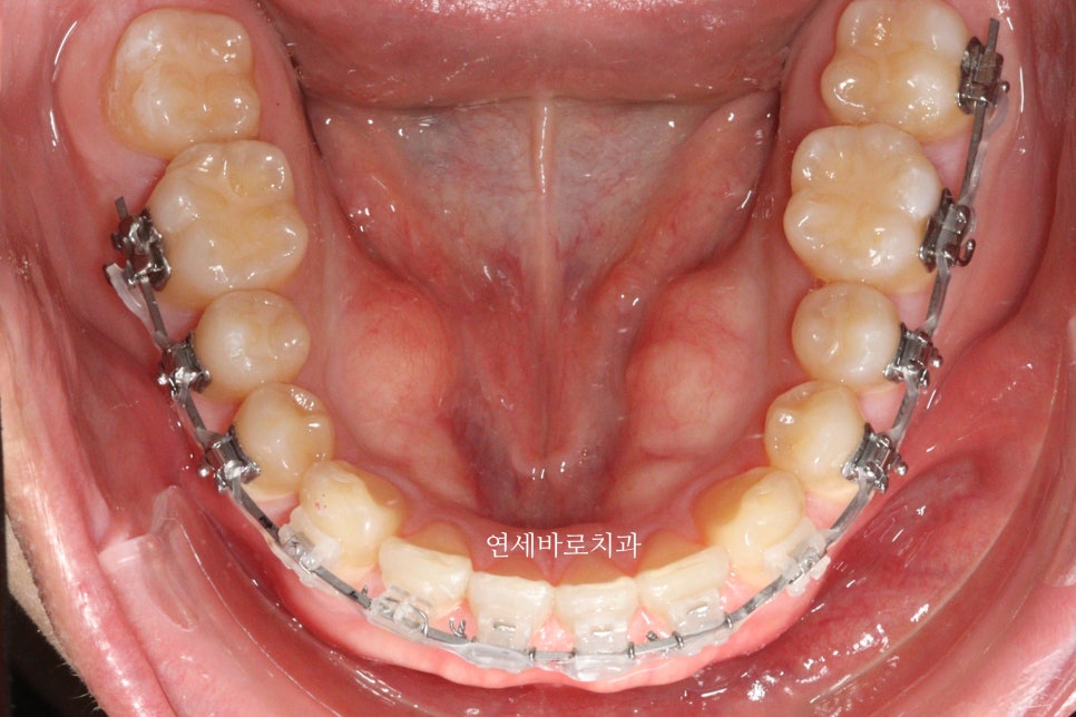 벌어진 치아교정 / 고정식 철사 유지장치의 필요성과 유지장치 이유