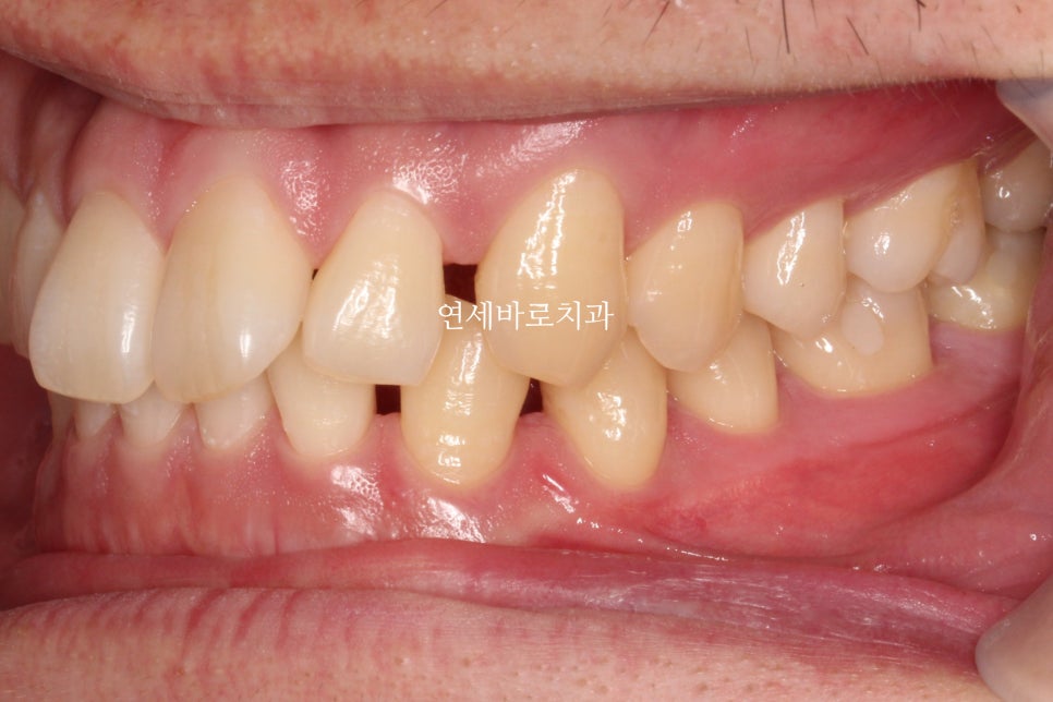 벌어진 치아교정 / 고정식 철사 유지장치의 필요성과 유지장치 이유