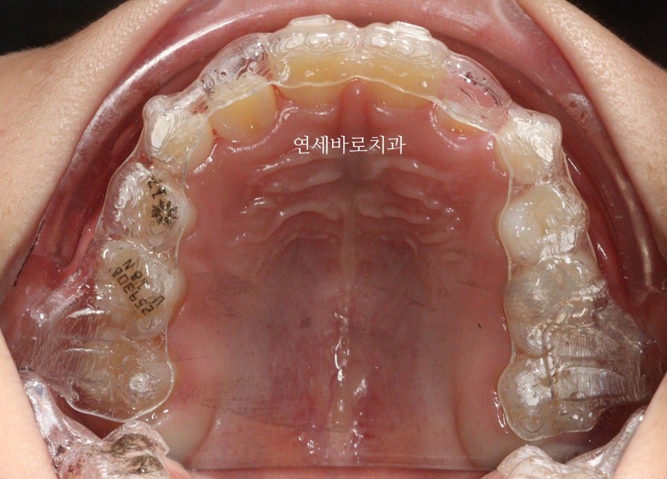 치과의사들이 말하지 않는 인비절라인 비밀 5가지