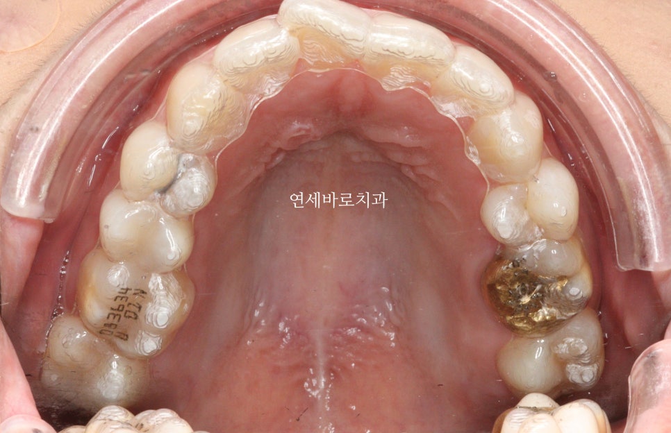 치과의사들이 말하지 않는 인비절라인 비밀 5가지