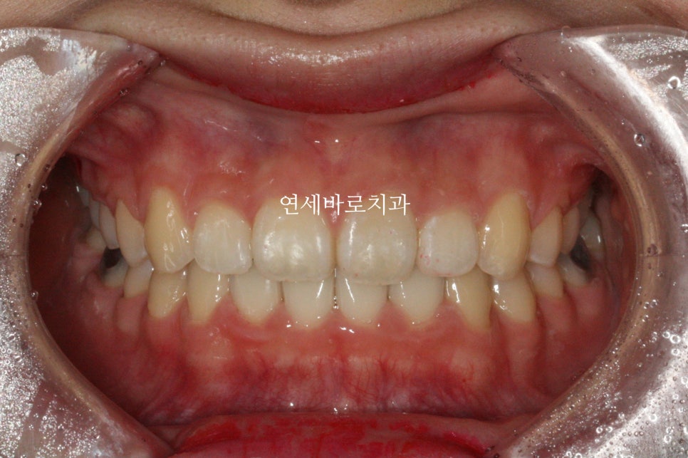 데이몬 클리피씨 교정장치 병원마다 추천이 다른 이유