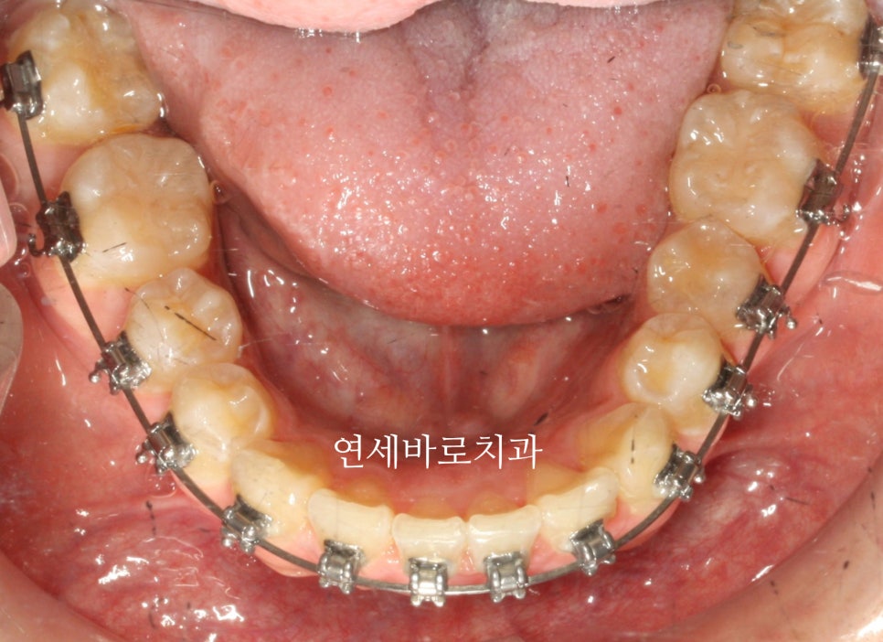 데이몬 클리피씨 교정장치 병원마다 추천이 다른 이유