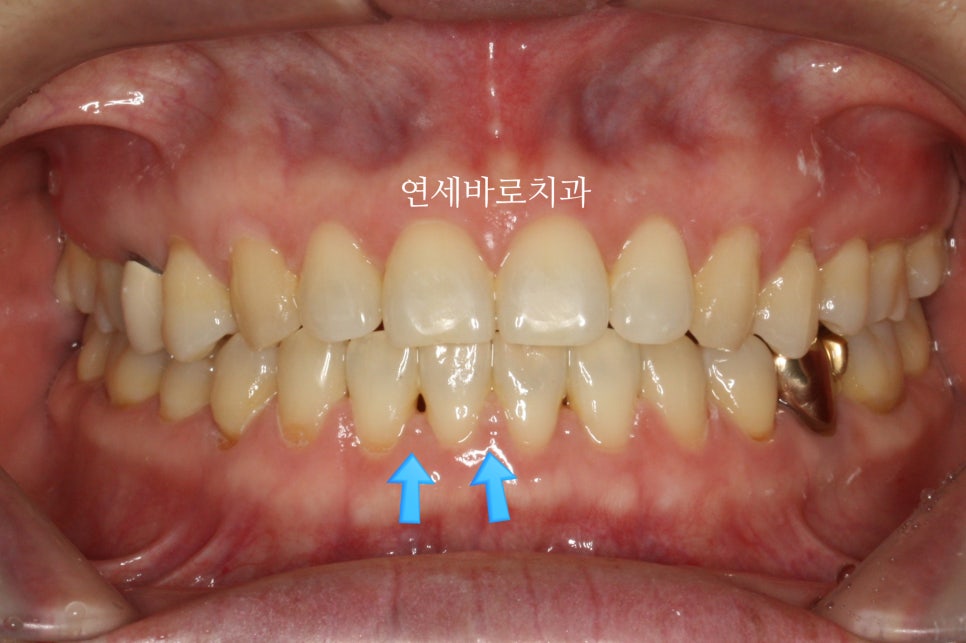 교정 부작용// 블랙트라이앵글 논문 저자가 직접 알려드립니다.