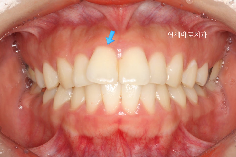 교정 부작용// 블랙트라이앵글 논문 저자가 직접 알려드립니다.