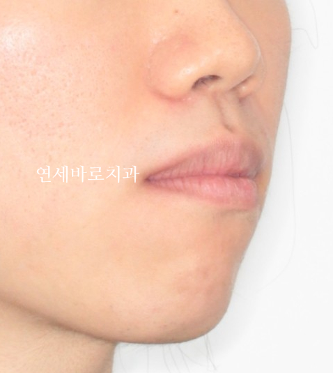 교정 부작용// 블랙트라이앵글 논문 저자가 직접 알려드립니다.