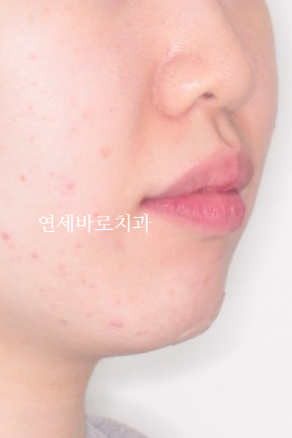 잇몸돌출 교정치료 후기 정리 + 크라운이 있어도 교정 가능한가요?