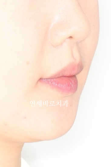 잇몸돌출 교정치료 후기 정리 + 크라운이 있어도 교정 가능한가요?