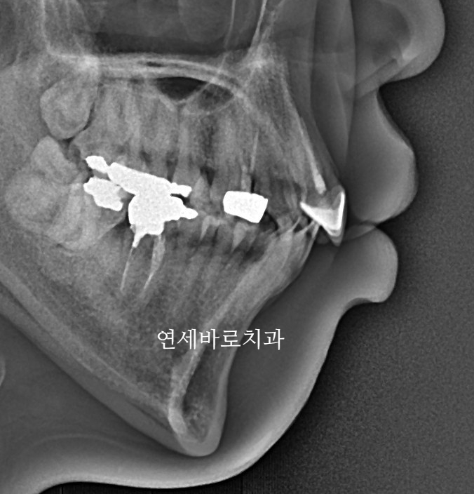 잇몸돌출 교정치료 후기 정리 + 크라운이 있어도 교정 가능한가요?