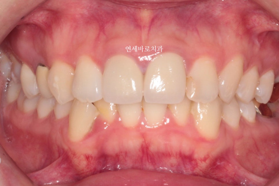 잇몸돌출 교정치료 후기 정리 + 크라운이 있어도 교정 가능한가요?