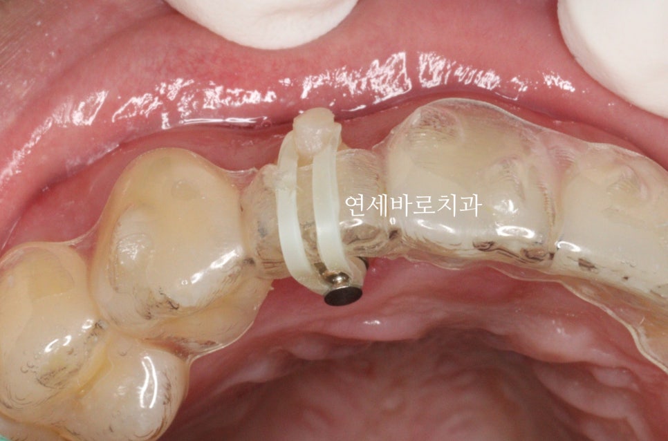 인비절라인 전문치과에서 인비절라인 치료받으면 위험?!