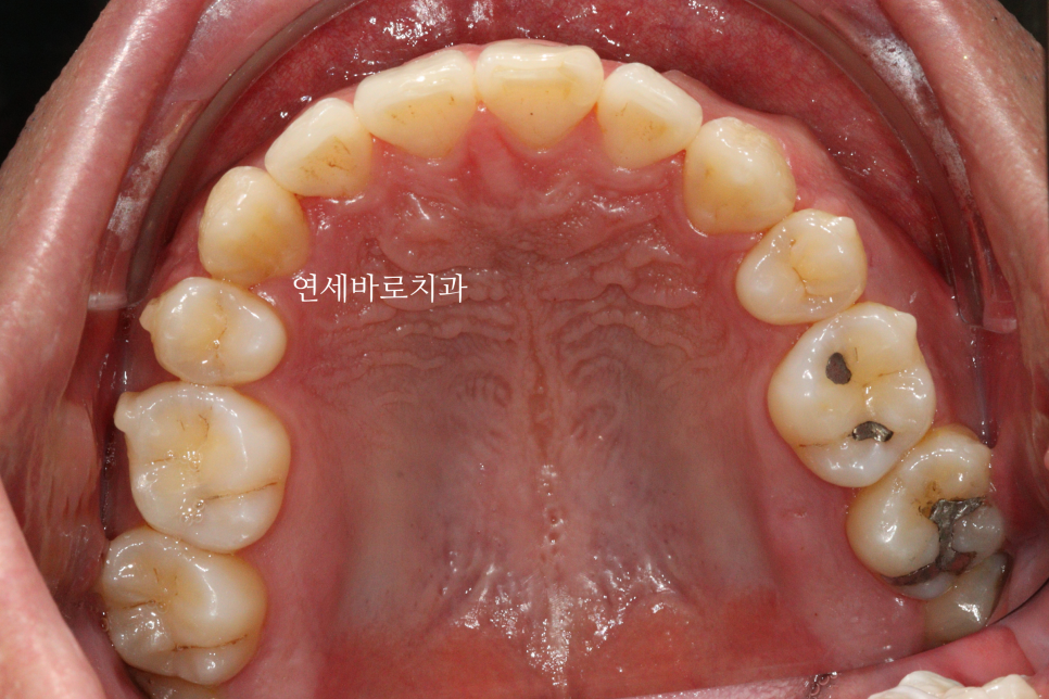 인비절라인 발치 교정, 발치는 언제하나요?