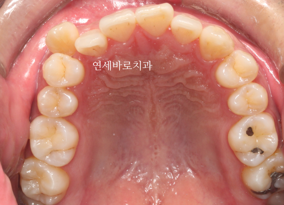 인비절라인 발치 교정, 발치는 언제하나요?
