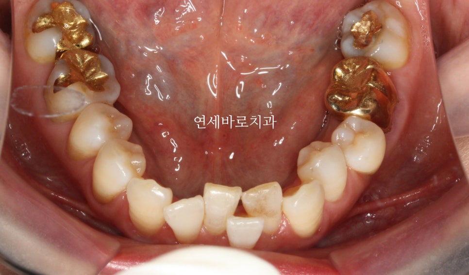 60대 우리 이모 부분 치아 교정 후기