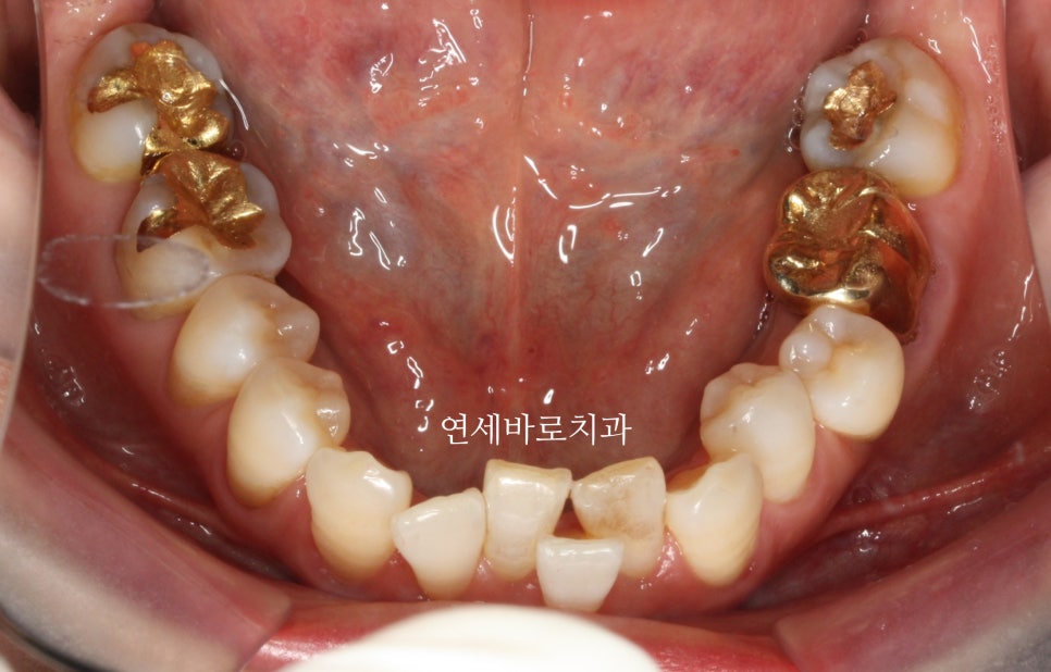 60대 우리 이모 부분 치아 교정 후기