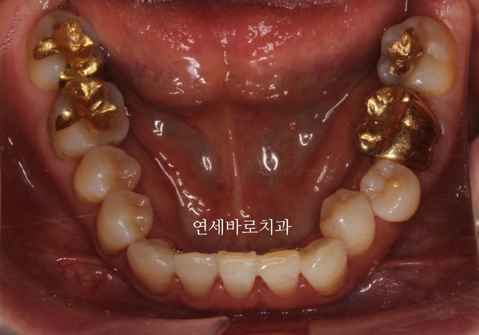 60대 우리 이모 부분 치아 교정 후기