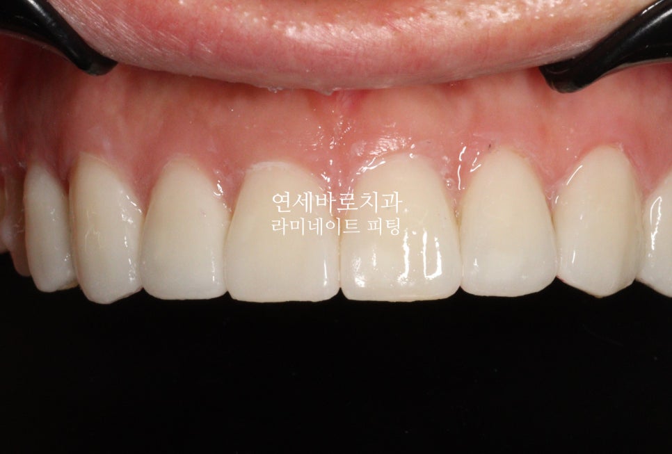 라미네이트 깨짐 *_* 무삭제라미네이트 젤라미, 인비절라인 후 진행한 후기 기록