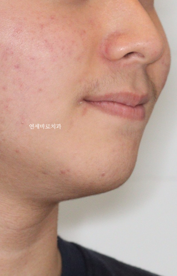 앞니 부분교정만큼 좋은 인비절라인라이트 이야기