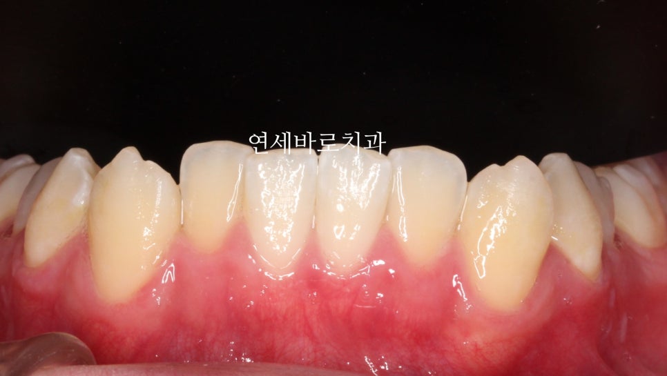 앞니 부분교정만큼 좋은 인비절라인라이트 이야기