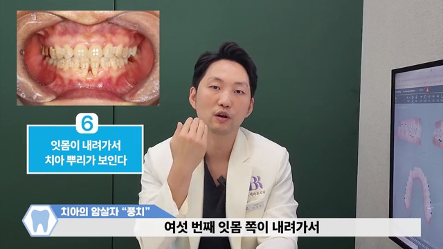 이도 뼈도 사라지는 치아의 암살자! 풍치를 예방하는 방법(with 자가진단법) #풍치 #잇몸약