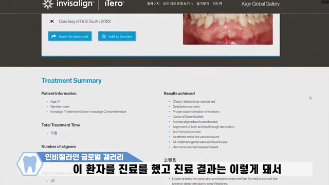 인비절라인 잘 하는 치과 고르는 꿀팁! #인비절라인 #투명교정