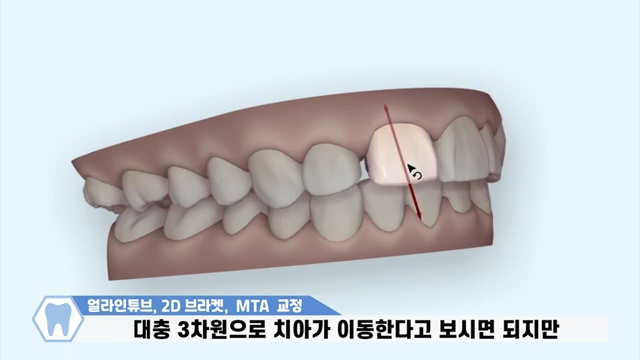 부분교정하기 전에 꼭 확인하세요! / #2d교정 #MTA #얼라인튜브