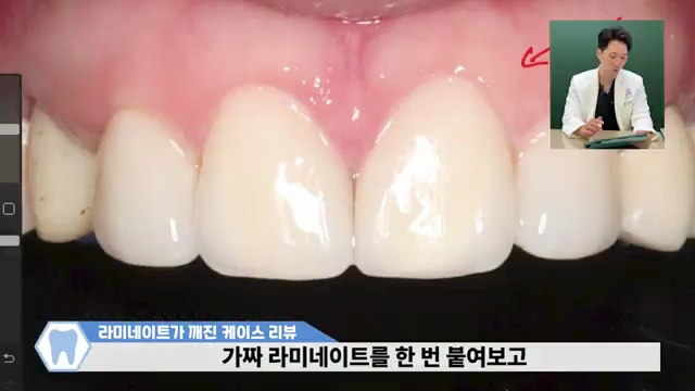 [깨진 라미네이트] 무삭제 라미네이트 재치료 케이스 리뷰! (feat.젤라미)