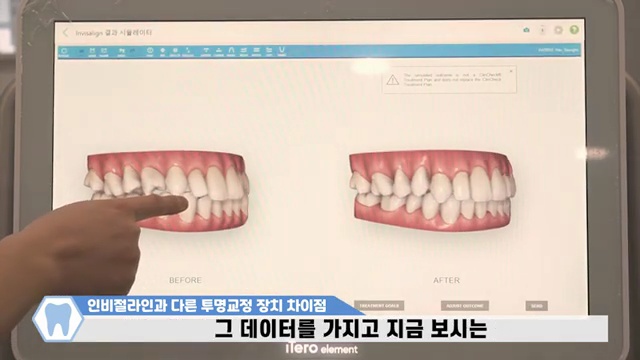 인비절라인 vs 다른 투명교정, 진짜 차이점은? 치과의사가 알려주는 진실