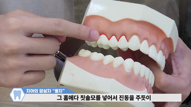 이도 뼈도 사라지는 치아의 암살자! 풍치를 예방하는 방법(with 자가진단법) #풍치 #잇몸약