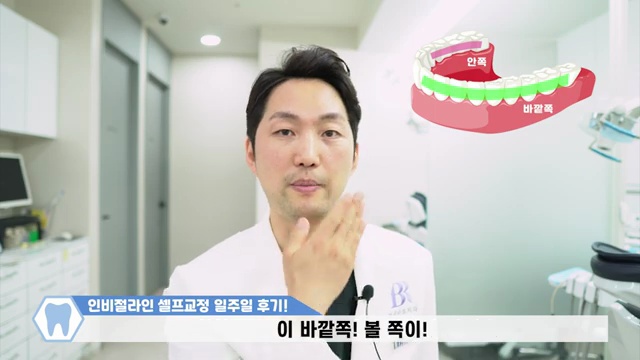 치과의사가 말해주는 인비절라인 일주일 리얼 교정후기 / #인비절라인 #투명교정